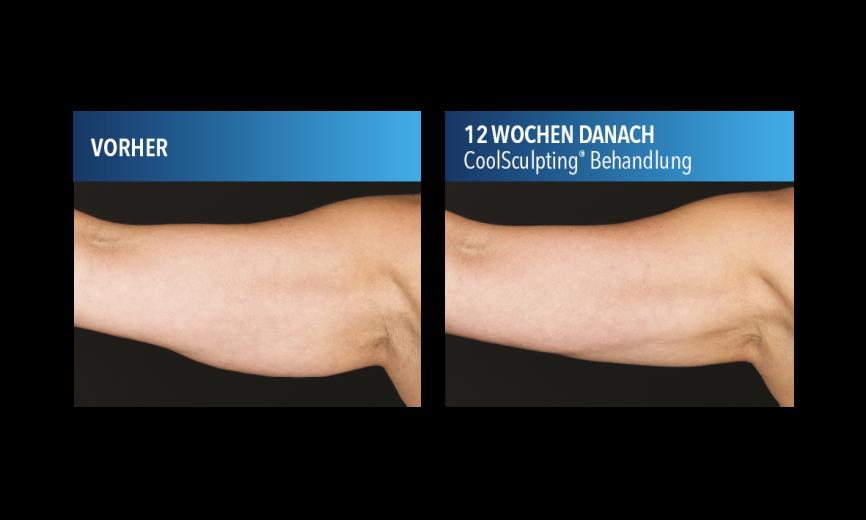 CoolSculpting (Kryolipolyse) Münster Fettreduktion ohne OP,